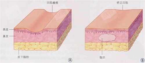 脂肪填充图片