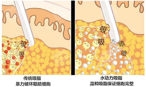 水动力吸脂图