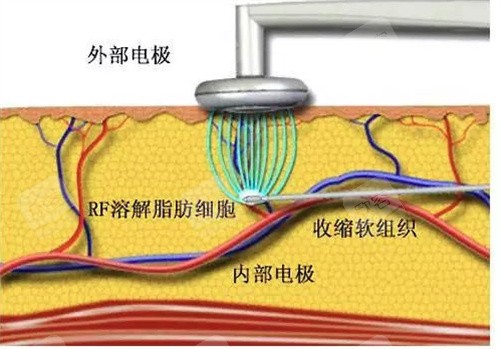 传统吸脂器