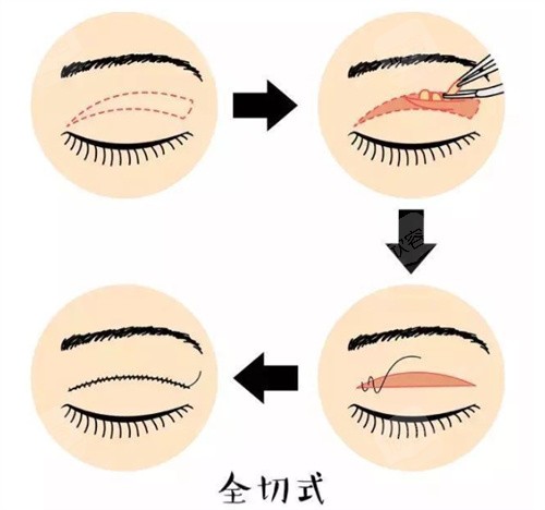 切开式双眼皮