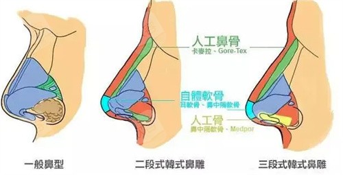 鼻型图