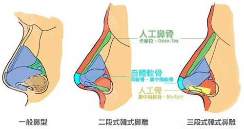 鼻型图