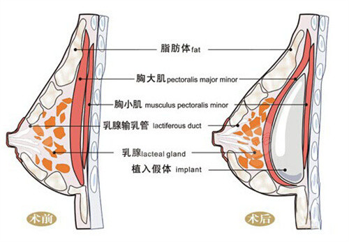 假体隆胸前后对比图