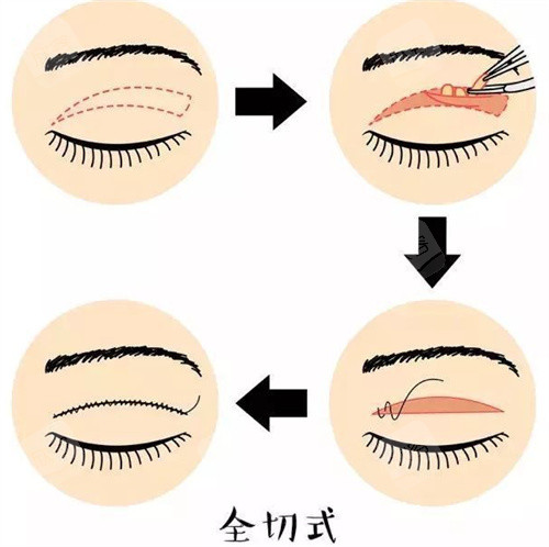 全切式双眼皮图