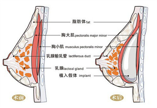 假体隆胸前后对比图