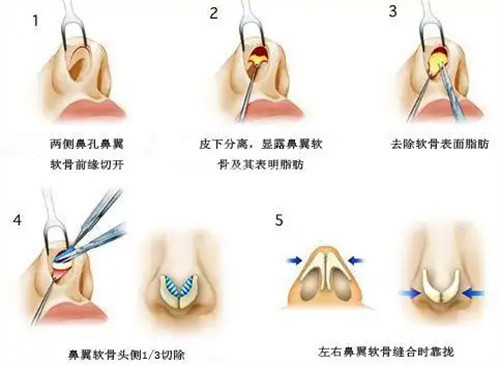 鼻子手术图