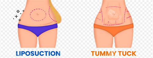 吸脂手术前后对比