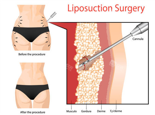 吸脂手术在皮肤组织里工作