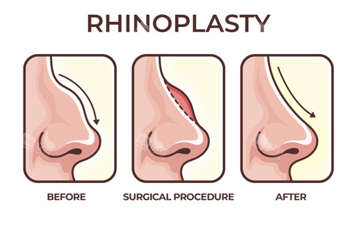 改善鼻子形态手术前后对比