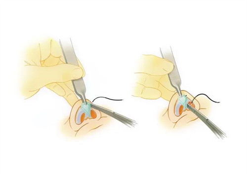 鼻整形手术缝合中