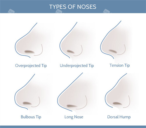 可以通过隆鼻手术矫正的鼻子形状