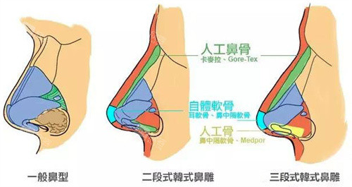 鼻型图