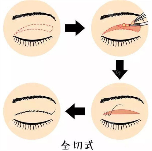 全切式双眼皮图