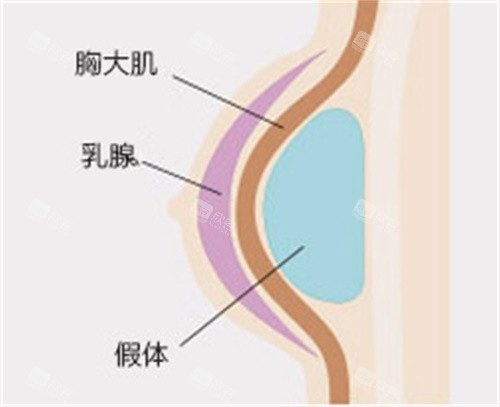 隆胸结构图