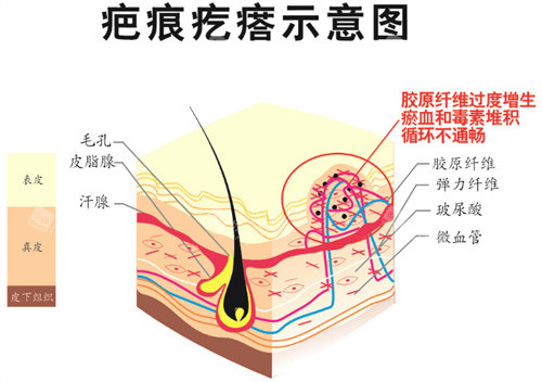 疤痕疙瘩示意图