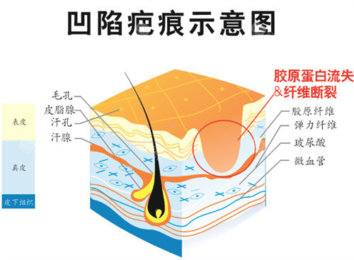 凹陷疤痕图