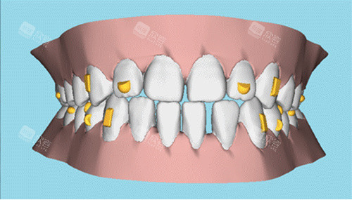 牙齿矫正图