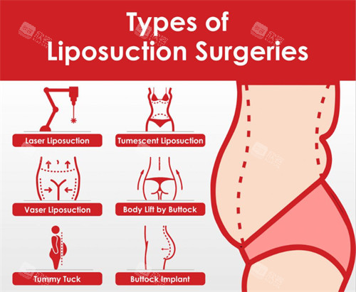 吸脂手术可进行的部位