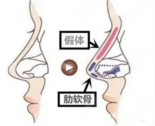 假体隆鼻示意图