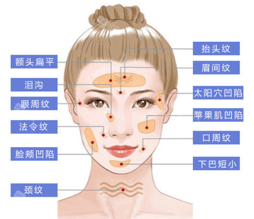 脂肪填充部位图示