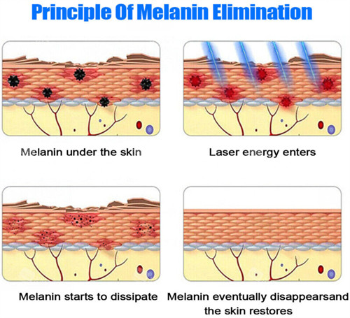 激光祛斑原理图示