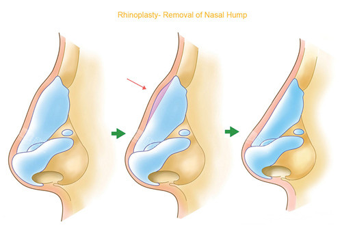 隆鼻过程图示