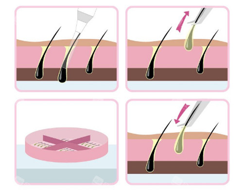 植发过程图示