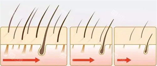 毛囊变化图