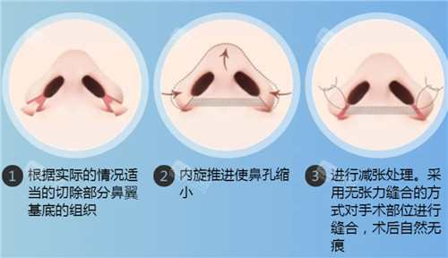 鼻翼缩小手术图示