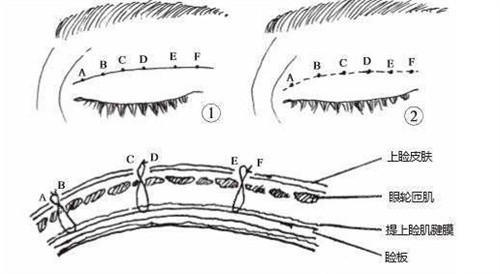 双眼皮缝合动画图