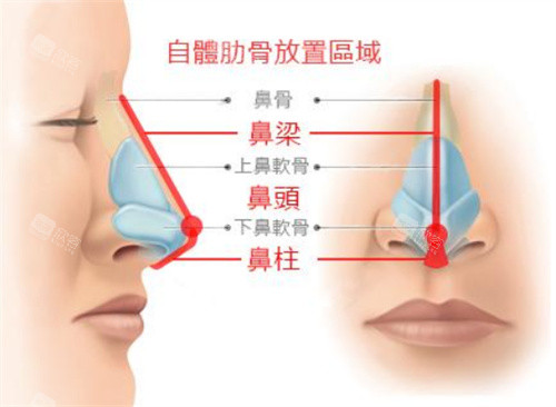 隆鼻前后对比图