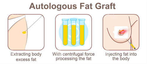 自体脂肪隆胸