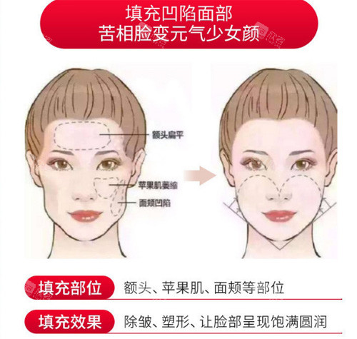 脂肪填充部位展示图