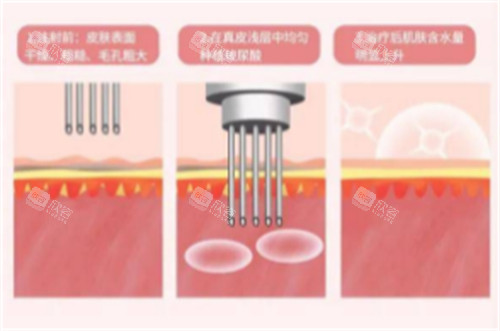 注射水光的过程图解