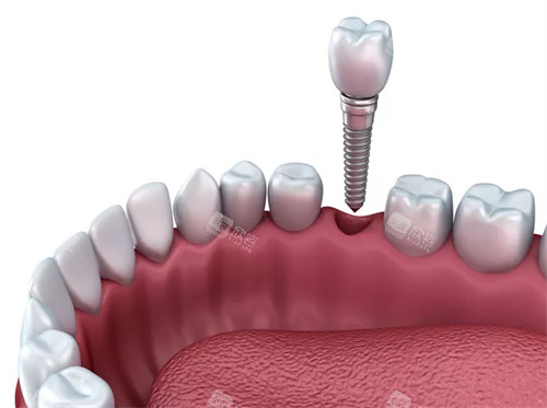 单颗种植牙的种植过程图解