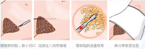 吸脂动画图