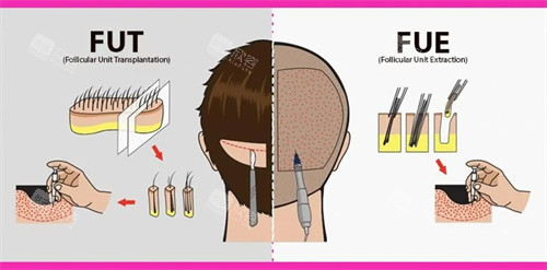 不同植发手术的对比