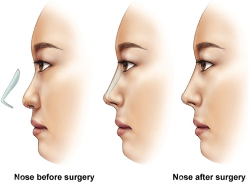 假体隆鼻手术前后对比