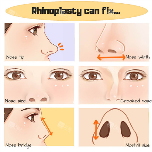 鼻修复过程