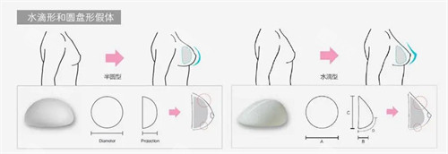不同形状假体植入胸部后的呈现