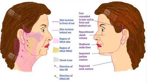 面部拉皮手术切口和剥离范围