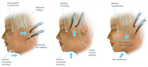 拉皮手术不同的切口方式和提拉方向