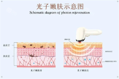 青岛做光子嫩肤多少钱一次?300一次和一千一次的有什么区别?