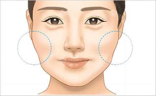 颧骨机脸颊下垂示例图