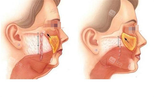 拉皮手术皮下组织切面对比展示图