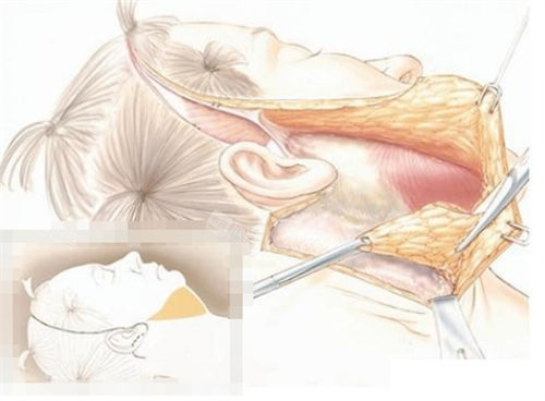 拉皮手术过程展示平面图