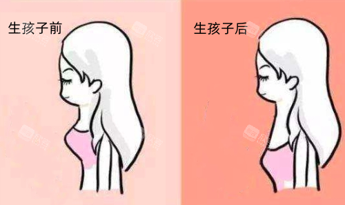 乳房下垂了怎么办？双环矫正和塑形悬吊矫正帮你回归自信！