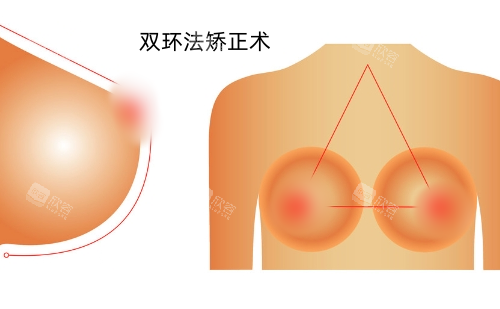 双环法乳房下垂矫正展示图