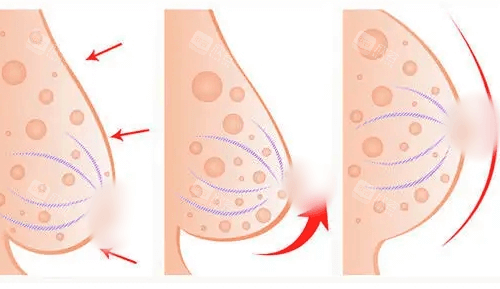 乳房塑形悬吊矫正术