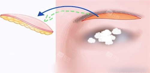 切眉眉下切口脂肪去除示意图